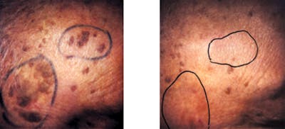 Laser Resurfacing Before & After Gallery - Patient 879641 - Image 1