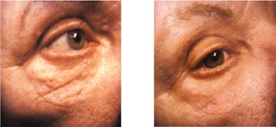 Laser Resurfacing Before & After Gallery - Patient 151047 - Image 1
