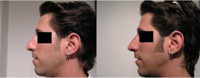 Liquid Rhinoplasty Before & After Gallery - Patient 380262 - Image 1