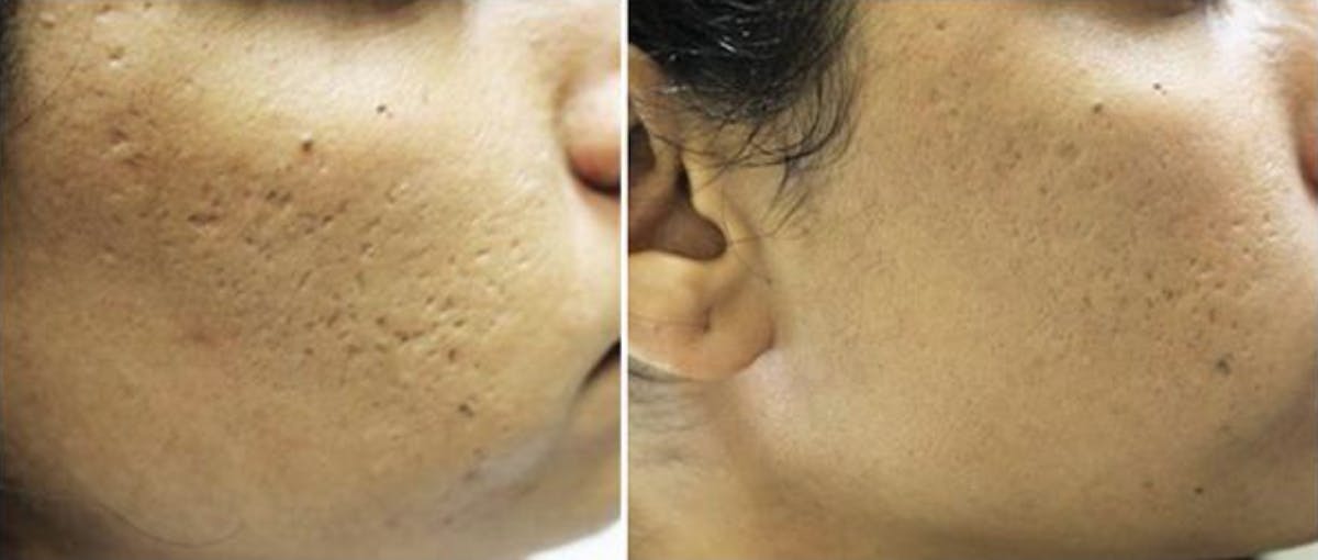 Microneedling Before & After Gallery - Patient 223758 - Image 1