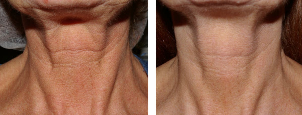 Microneedling Before & After Gallery - Patient 950839 - Image 1