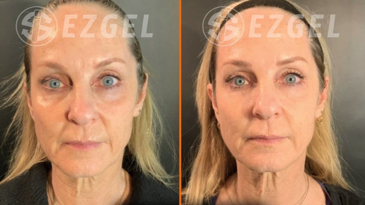 Patient 284300 Gel Lift Before & After Photos Gambhir Cosmetic Medicine