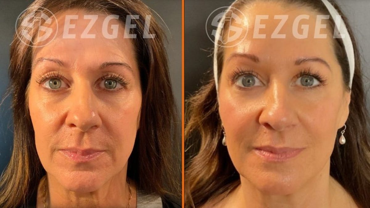 Gel Lift Before & After Gallery - Patient 190432 - Image 1