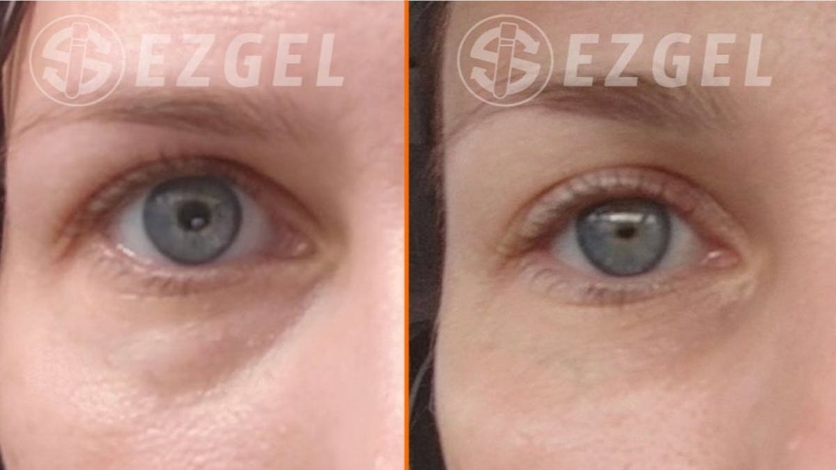 Gel Lift Before & After Gallery - Patient 259103 - Image 1