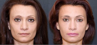 Sculptra Before & After Gallery - Patient 442819 - Image 1