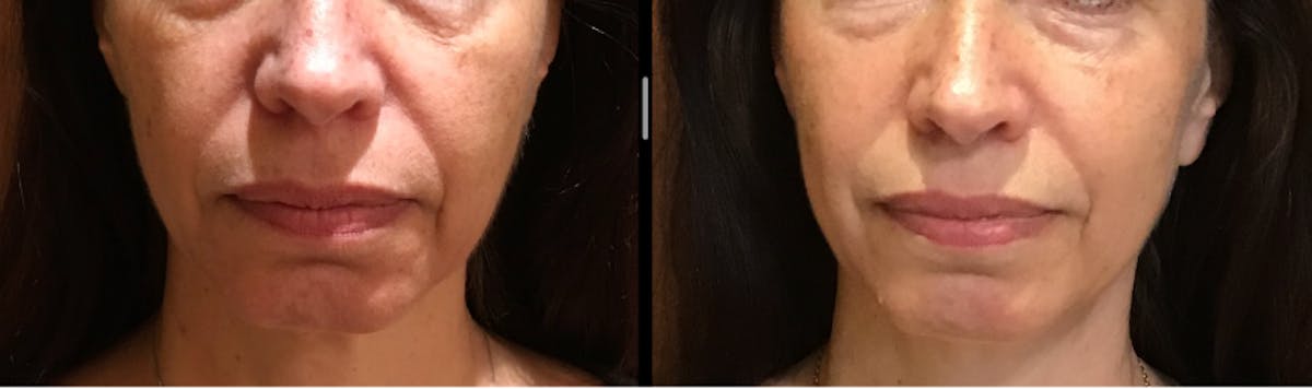 Sculptra Before & After Gallery - Patient 490141 - Image 1