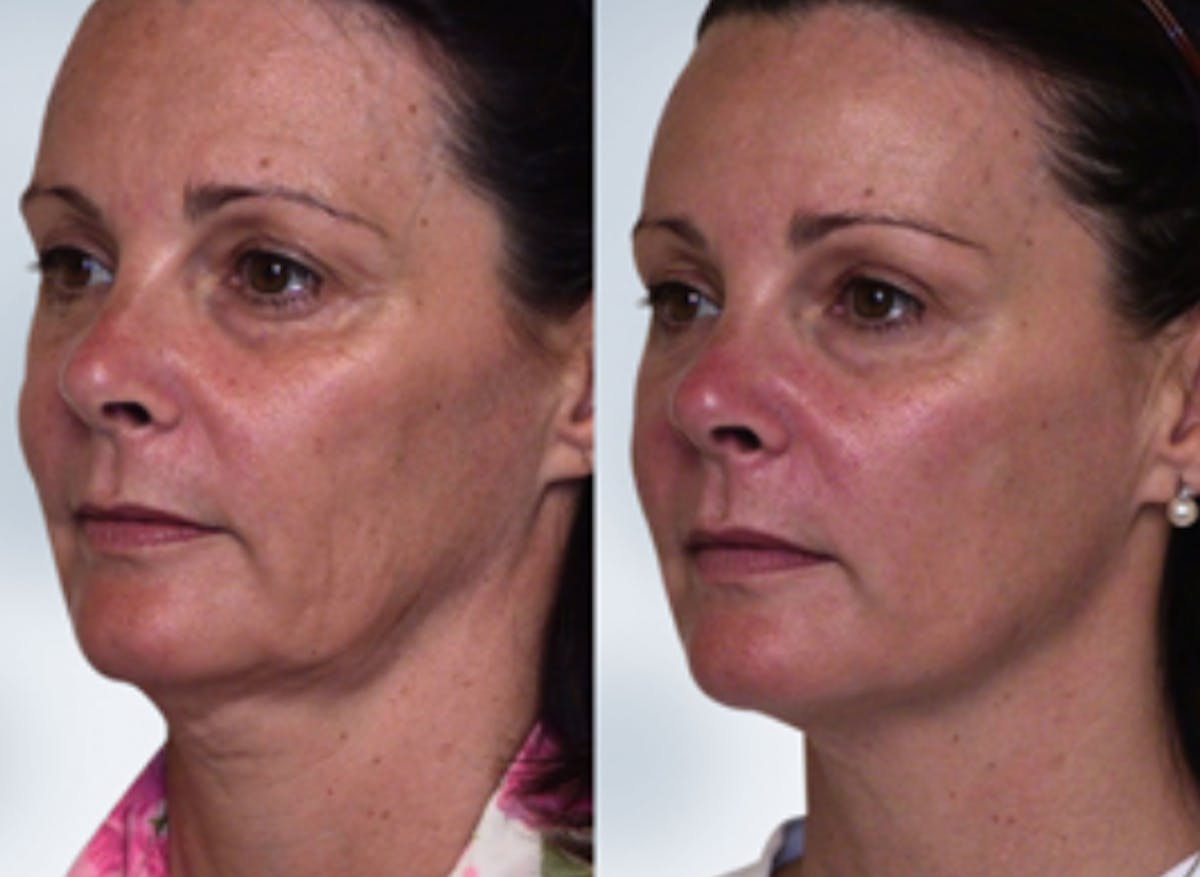 Sculptra Before & After Gallery - Patient 424274 - Image 1