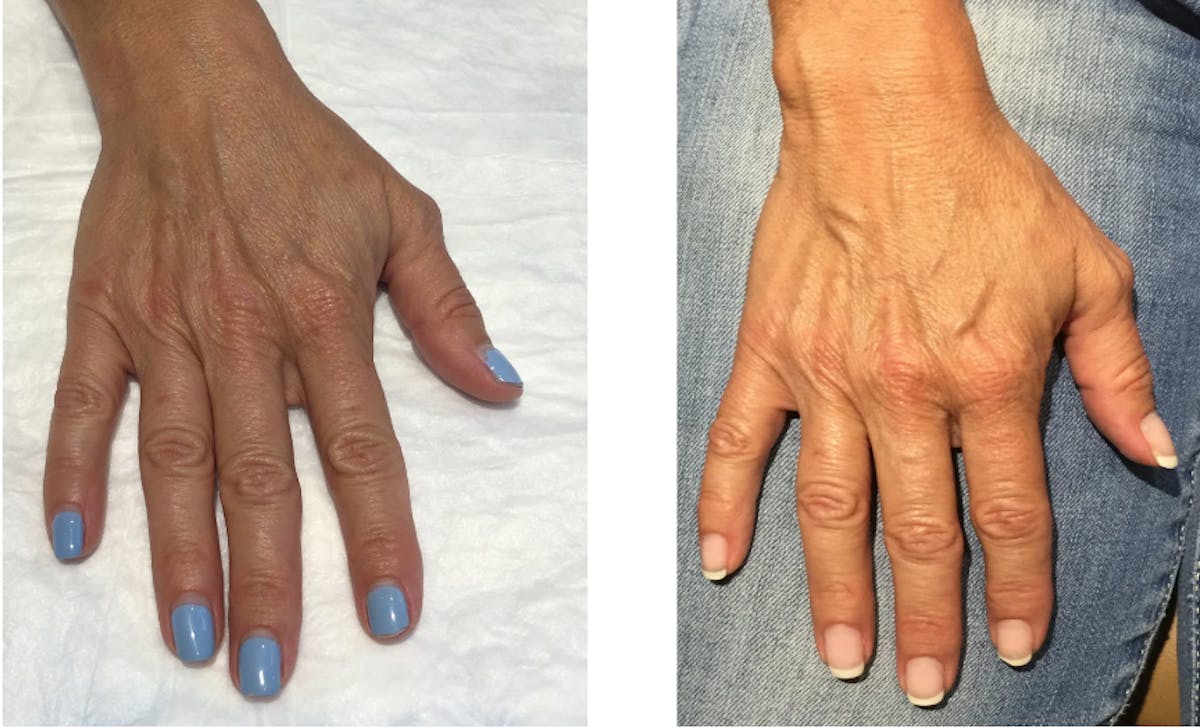 Sculptra Before & After Gallery - Patient 369862 - Image 1