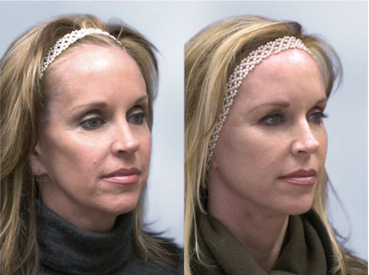 Sculptra Before & After Gallery - Patient 340491 - Image 1