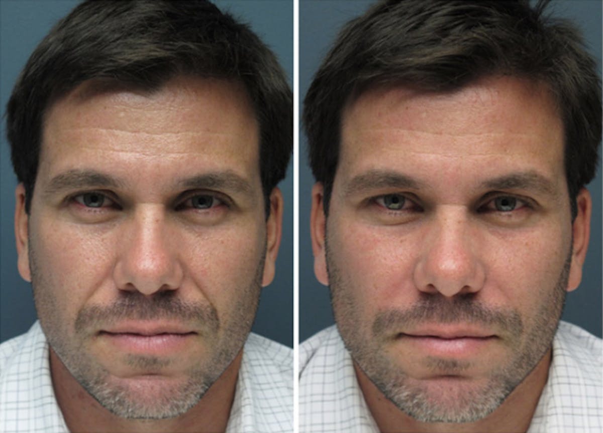 Sculptra Before & After Gallery - Patient 222110 - Image 1