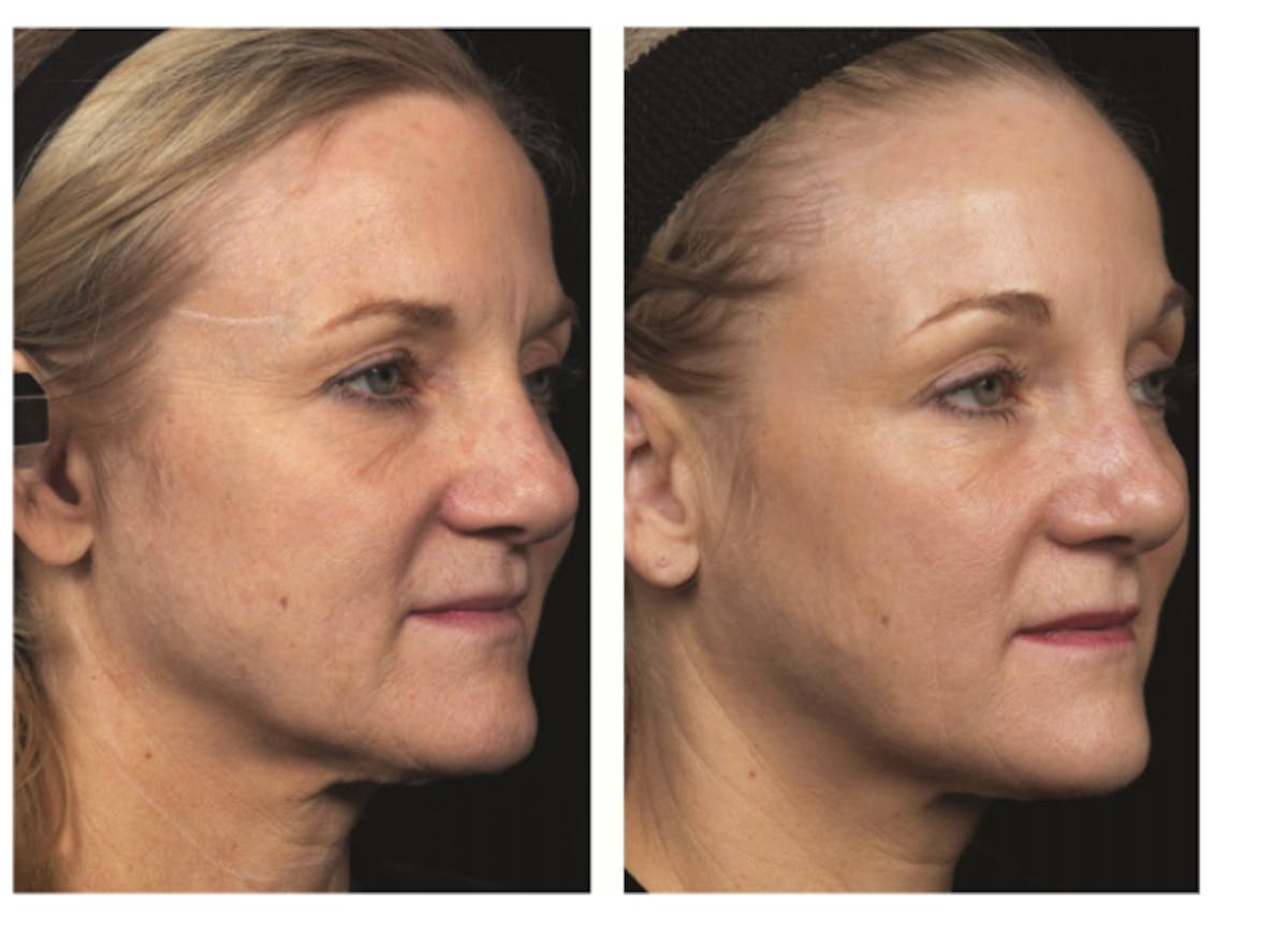Thermage Before & After Gallery - Patient 811048 - Image 1