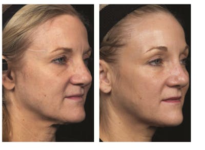 Thermage Before & After Gallery - Patient 811048 - Image 1