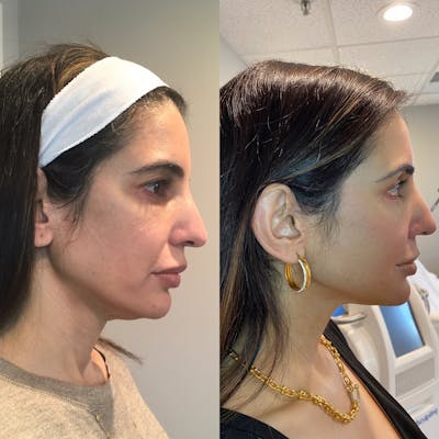 Thread Lift Before & After Gallery - Patient 296514 - Image 1