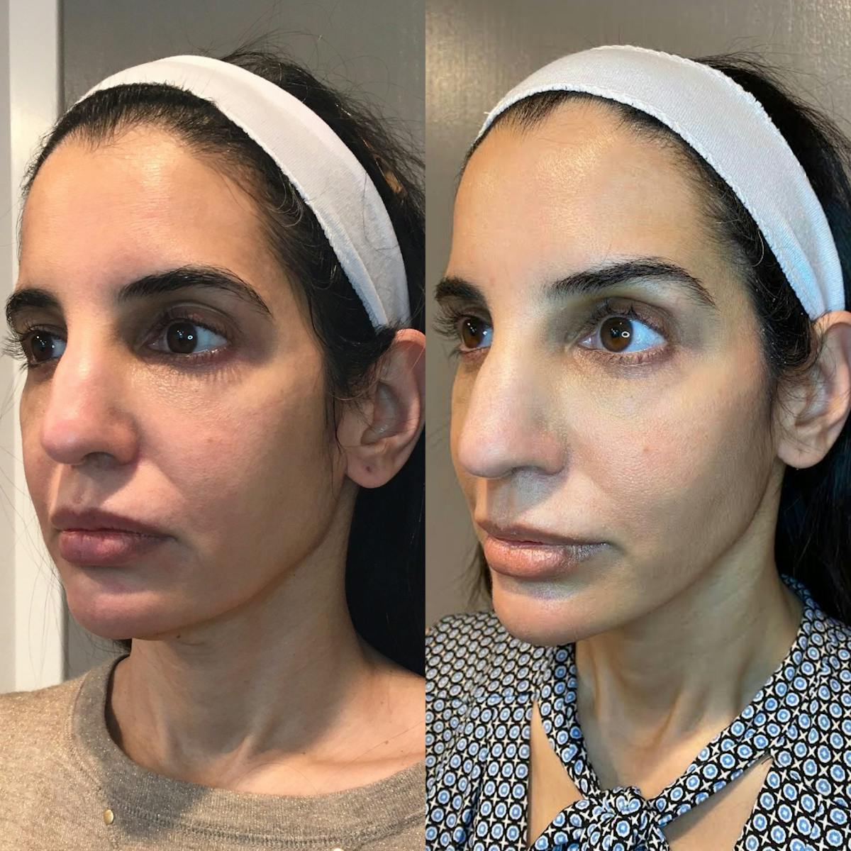 Thread Lift Before & After Gallery - Patient 296514 - Image 2