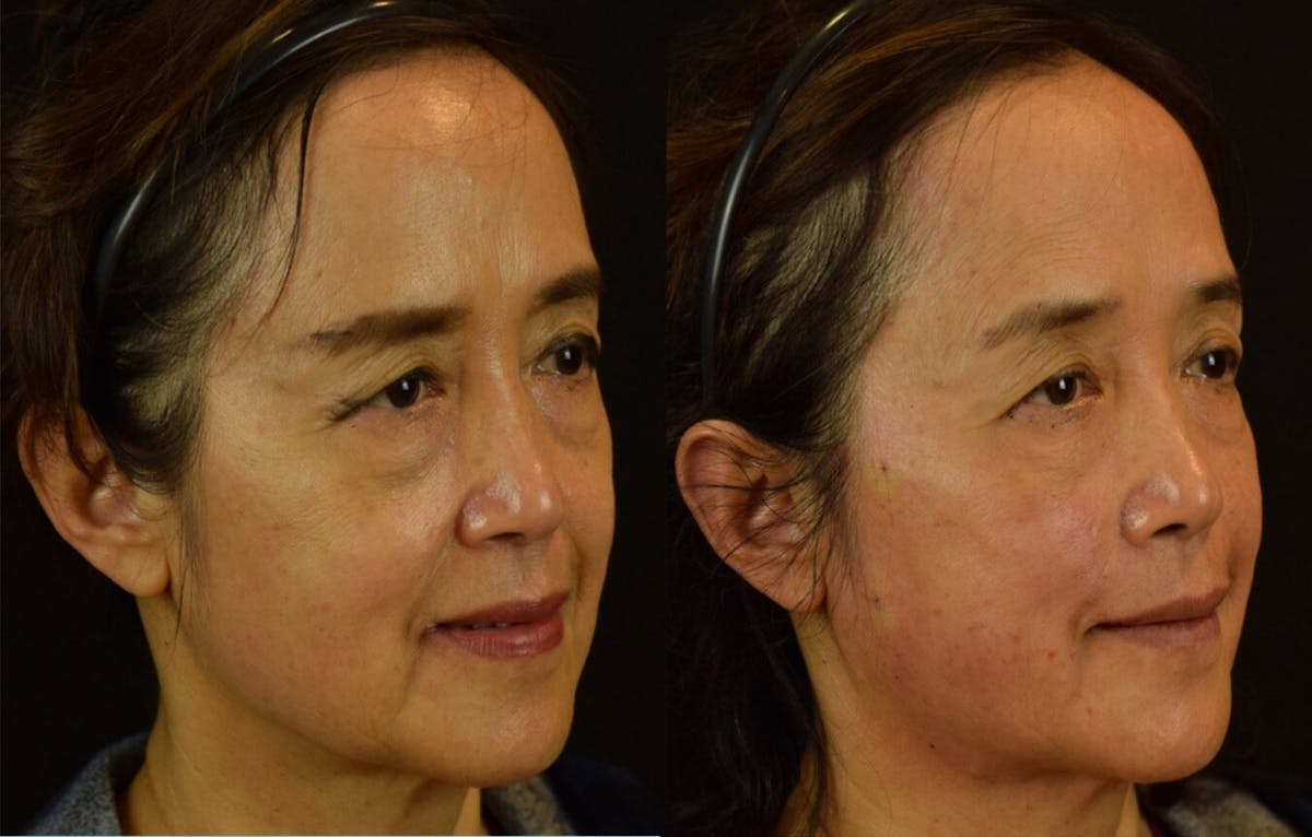Patient 278888 Thread Lift Before & After Photos Gambhir Cosmetic