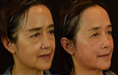 Thread Lift Before & After Gallery - Patient 278888 - Image 1