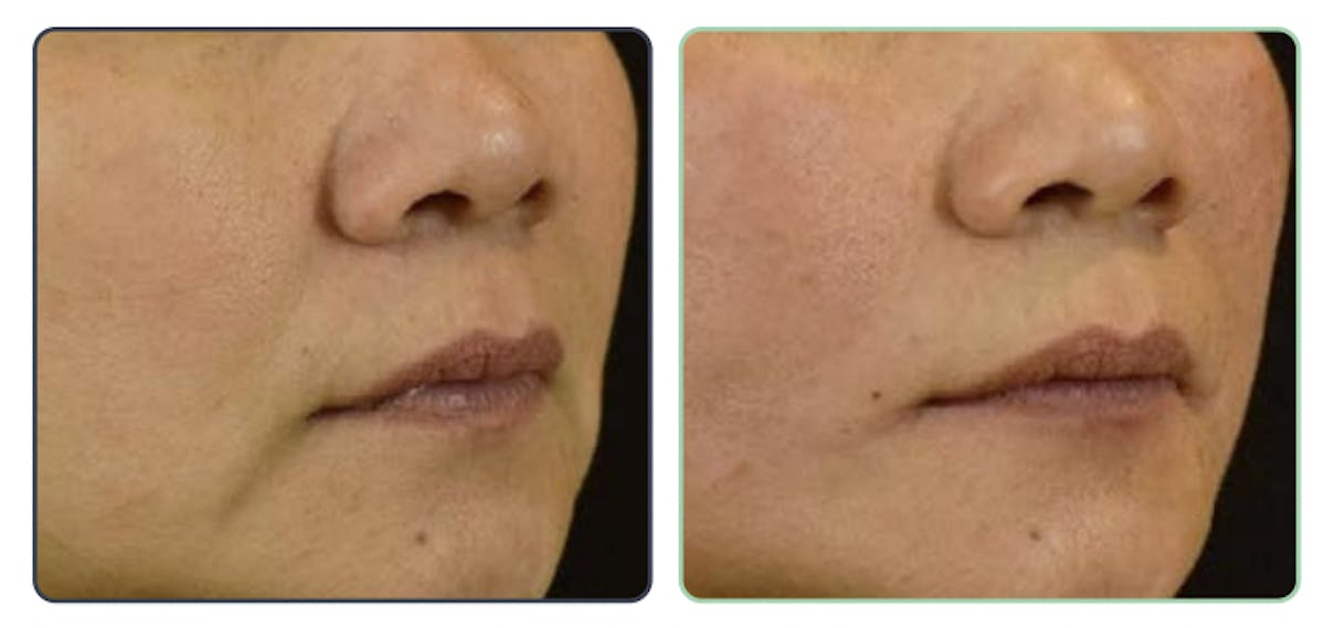 Thread Lift Before & After Gallery - Patient 282871 - Image 1
