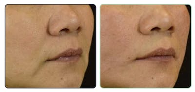 Thread Lift Before & After Gallery - Patient 282871 - Image 1