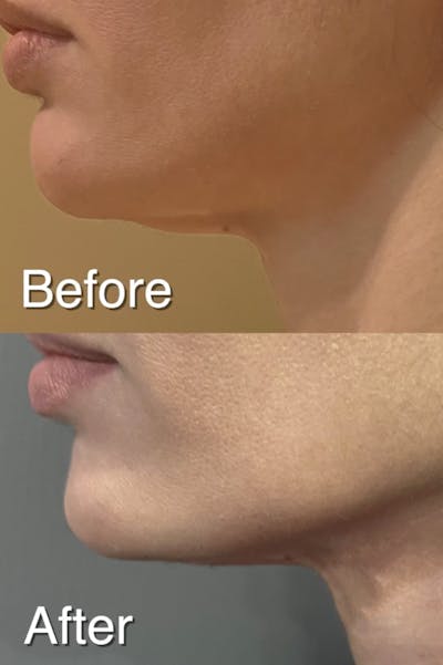 Thread Lift Before & After Gallery - Patient 115241 - Image 1