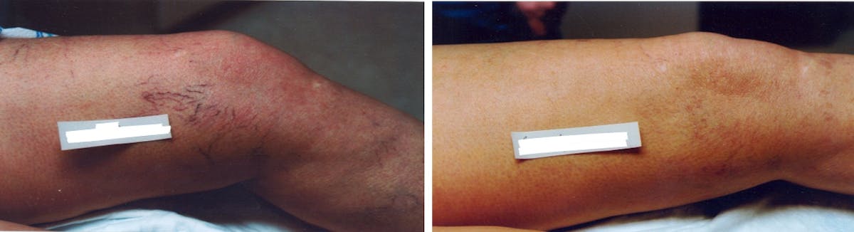 Vein Treatment Before & After Gallery - Patient 286068 - Image 1
