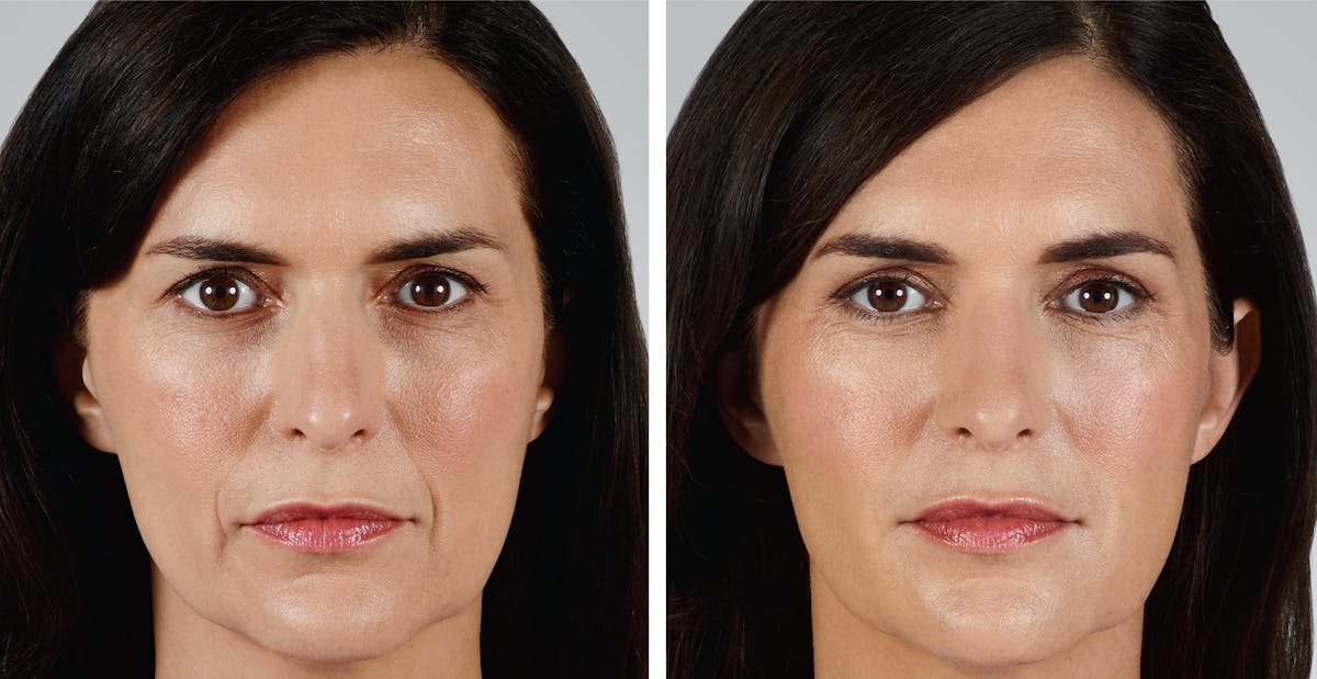 Vollure Before & After Gallery - Patient 129076 - Image 1