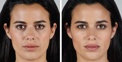 Vollure Before & After Gallery - Patient 394830 - Image 1