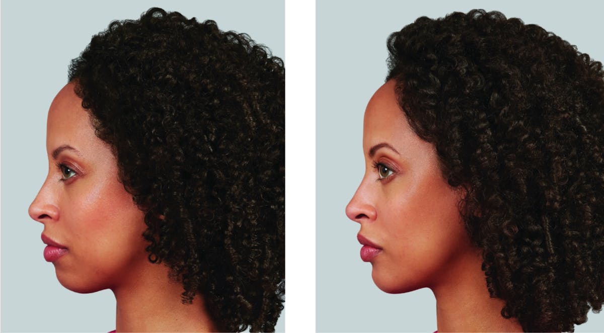 Voluma Before & After Gallery - Patient 129859 - Image 1