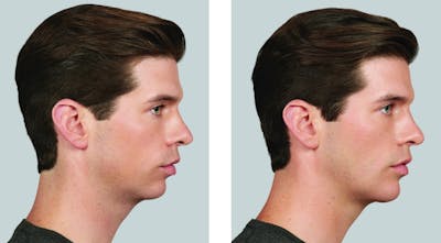 Voluma Before & After Gallery - Patient 865419 - Image 1