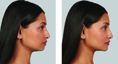 Voluma Before & After Gallery - Patient 245447 - Image 1