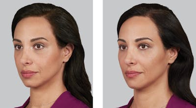 Voluma Before & After Gallery - Patient 261830 - Image 1