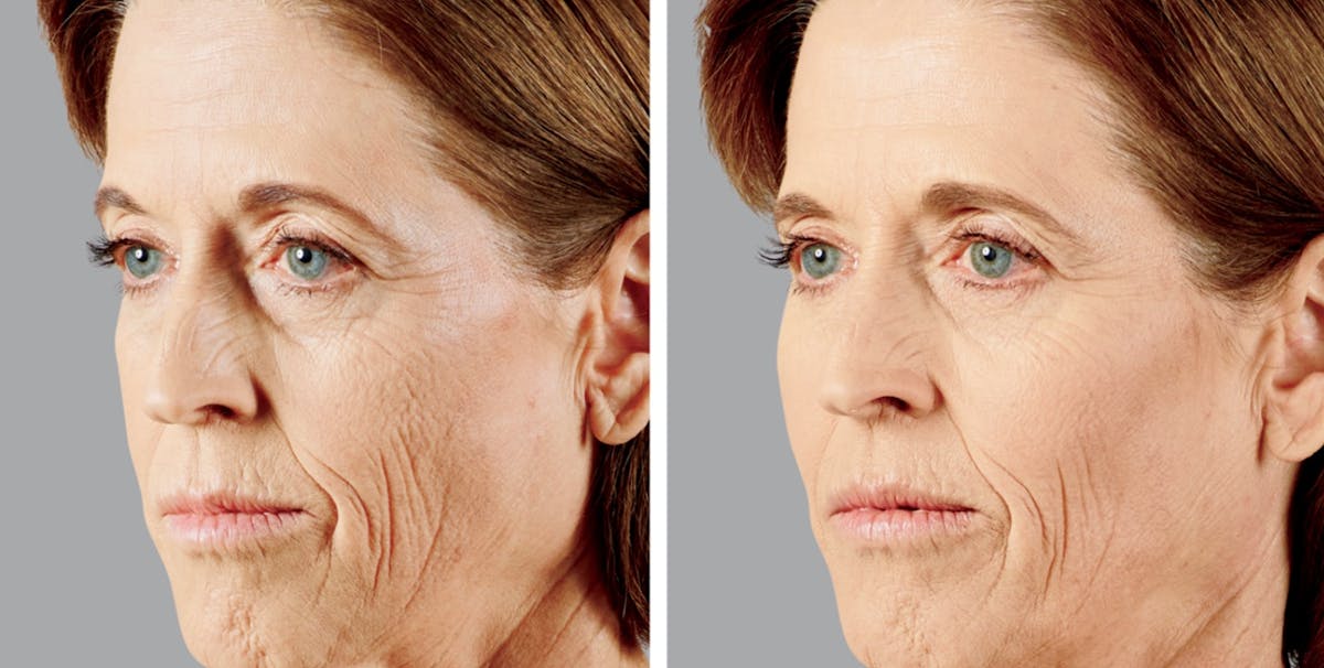 Voluma Before & After Gallery - Patient 153432 - Image 1