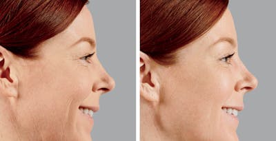 Voluma Before & After Gallery - Patient 230876 - Image 1