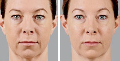 Voluma Before & After Gallery - Patient 411829 - Image 1