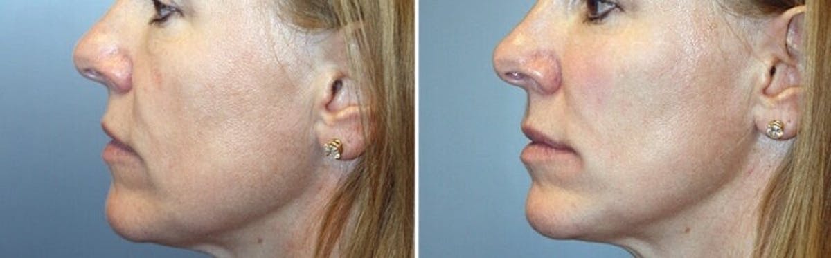 Voluma Before & After Gallery - Patient 376816 - Image 1