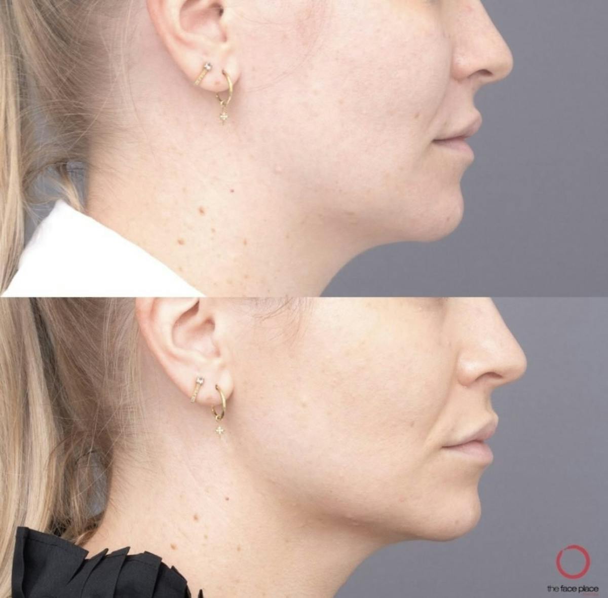 Volux Before & After Gallery - Patient 761181 - Image 1