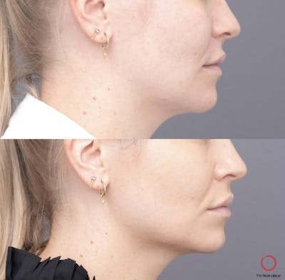 Volux Before & After Gallery - Patient 761181 - Image 1