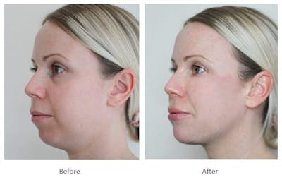 Volux Before & After Gallery - Patient 151314 - Image 1