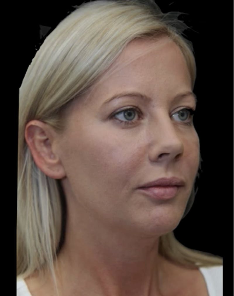 Dermal Fillers Before & After Gallery - Patient 838190 - Image 2