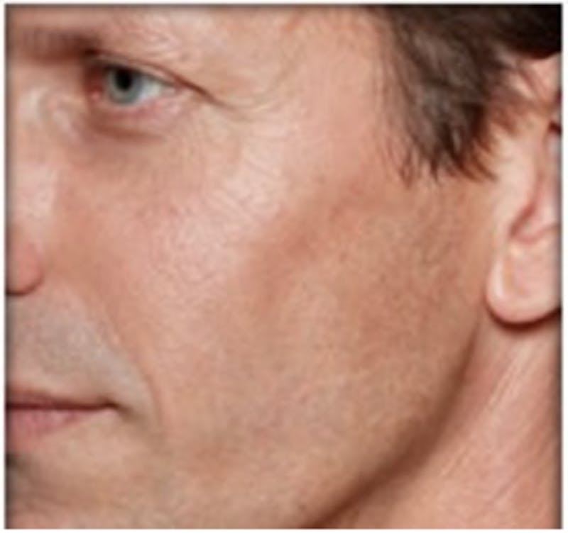 Dermal Fillers Before & After Gallery - Patient 187961 - Image 2