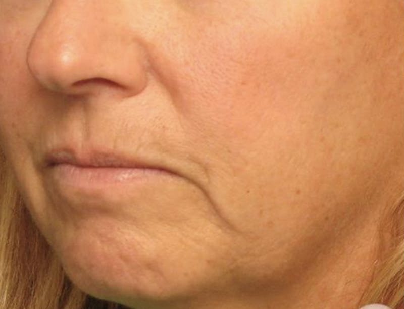 Dermal Fillers Before & After Gallery - Patient 183658 - Image 1