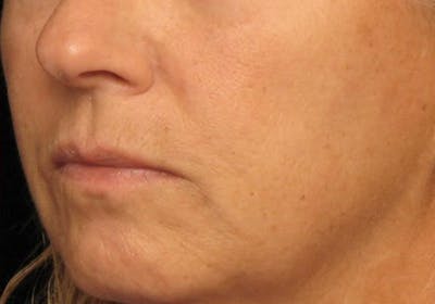 Dermal Fillers Before & After Gallery - Patient 183658 - Image 2
