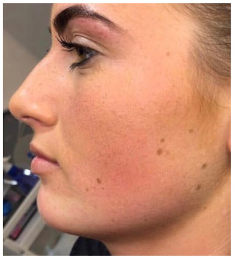 Dermal Fillers Before & After Gallery - Patient 259949 - Image 1