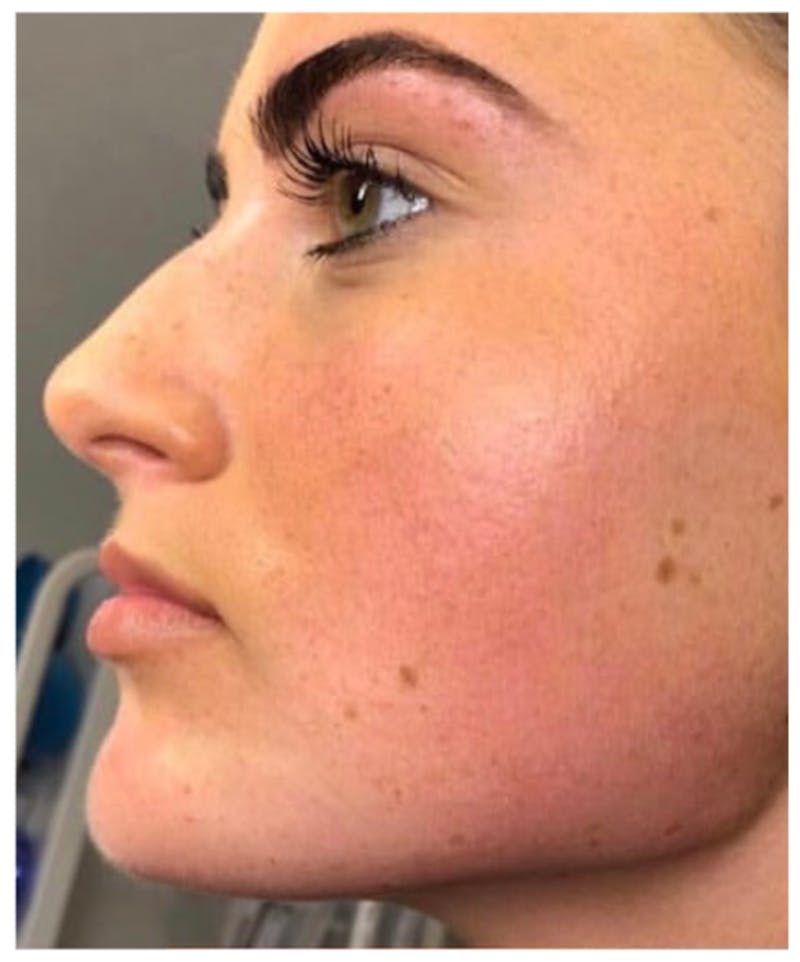Dermal Fillers Before & After Gallery - Patient 259949 - Image 2