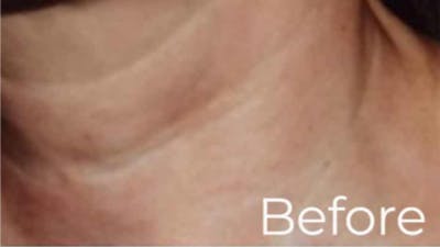Dermal Fillers Before & After Gallery - Patient 412344 - Image 1