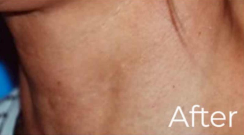 Dermal Fillers Before & After Gallery - Patient 412344 - Image 2
