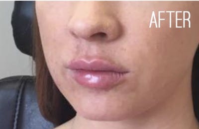 Dermal Fillers Before & After Gallery - Patient 802983 - Image 2