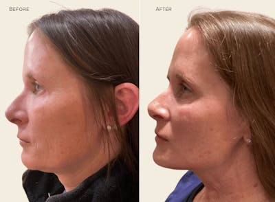 Chin Before & After Gallery - Patient 973500 - Image 1