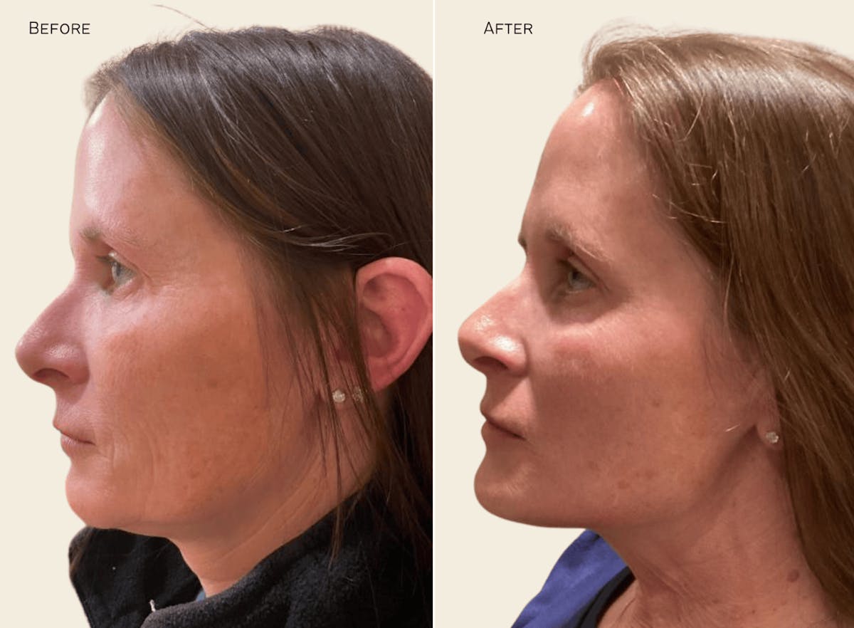 Jaw Before & After Gallery - Patient 912187 - Image 1