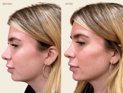 Chin Before & After Gallery - Patient 421165 - Image 1