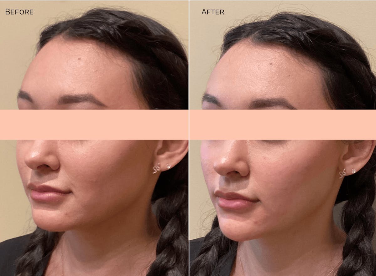 Chin Before & After Gallery - Patient 285811 - Image 1